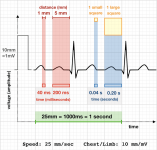 EKG_Chart_2.png